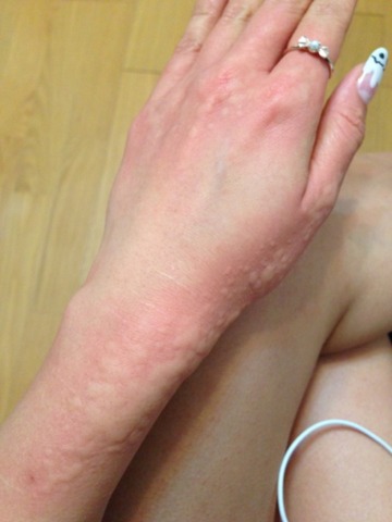 アレルギー 写真 鯖 蕁麻疹